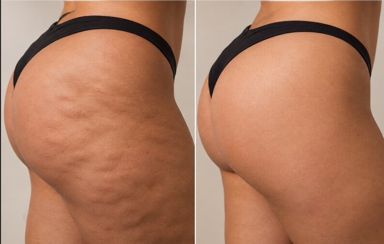 Antes e depois do uso do Sanctus BumBum Pró — região dos glúteos mais lisa e firme